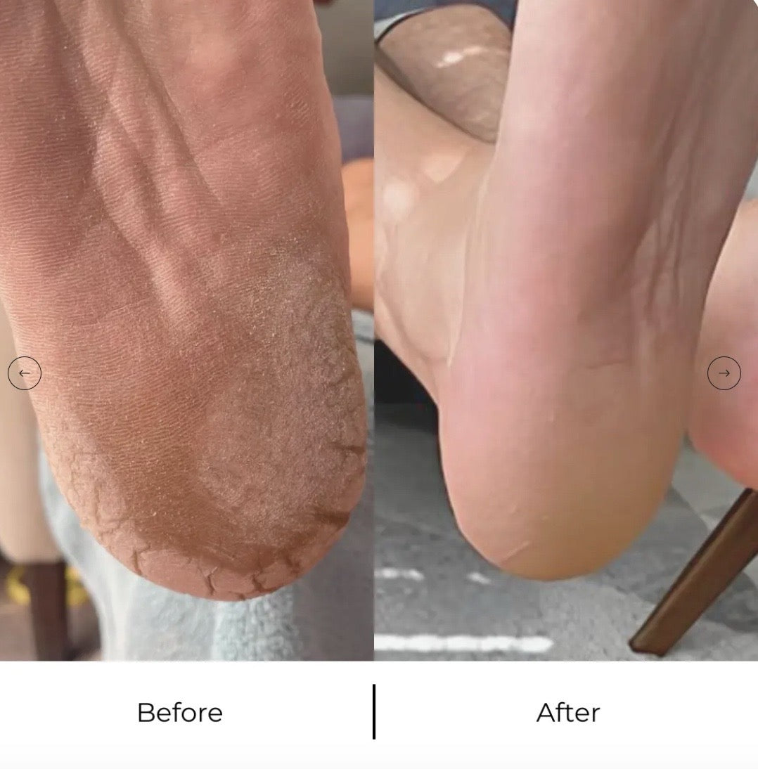 Eeltwisser Pro - Zodat jij weer zachte voeten hebt